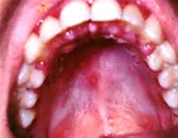 پاورپوینت مطالعه بیماری استوماتیت (ppt) 22 اسلاید